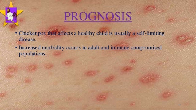 Adult chicken pox vaccine foto 426